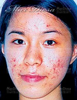 個案10:Nicole 治療前 個案10:Nicole 治療前