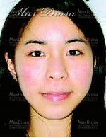 個案10:Nicole 治療後 個案10:Nicole 治療後
