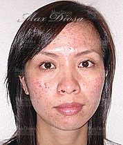 個案1:Karen 治療前 個案1:Karen 治療前