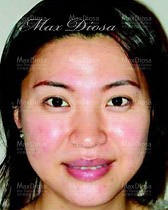 個案4:Mrs Lau 治療中 個案4:Mrs Lau 治療中