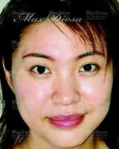 個案4:Mrs Lau 治療後 個案4:Mrs Lau 治療後