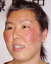 個案9:Jenny 治療前 個案9:Jenny 治療前