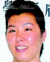 個案9:Jenny 治療中 個案9:Jenny 治療中