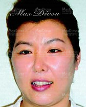 個案9:Jenny 治療後 個案9:Jenny 治療中