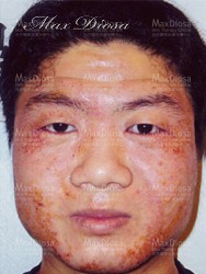 濕疹治療中(面部)* 濕疹治療中(面部)*