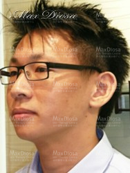 濕疹治療 後(面部)* 濕疹治療 後(面部)*