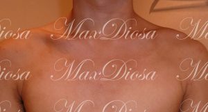 chest_After 濕疹治療後(胸)*