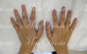 hand_after 濕疹治療後(手)*
