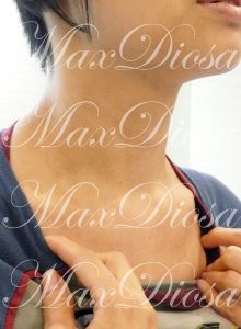 濕疹治療後(頸、腮、胸)* 濕疹治療後(頸、腮、胸)*