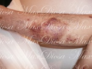濕疹治療前(腿)**