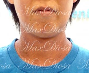 濕疹治療中(面部) 濕疹治療中(面部)