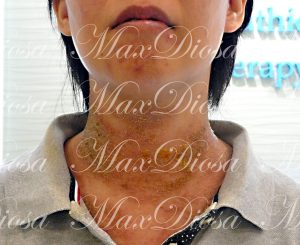 濕疹治療前(面手) 濕疹治療前(面手)