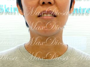 濕疹治療後(面手)